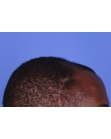 Before Hair Transplant&nbsp;Front
